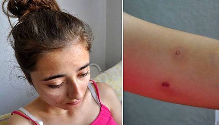 Genç Kız Evine Giderken Arıların Saldırısına Uğradı